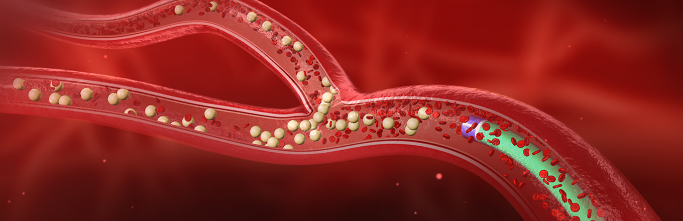 microspheres being released into a blood vessel