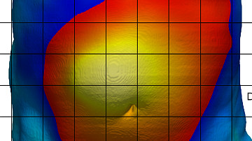 3D imaging yields drastic improvement in hernia surgery outcomes