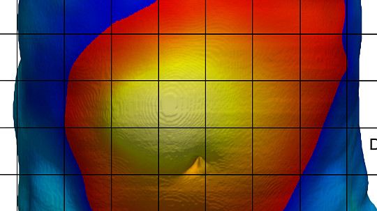 3D imaging yields drastic improvement in hernia surgery outcomes