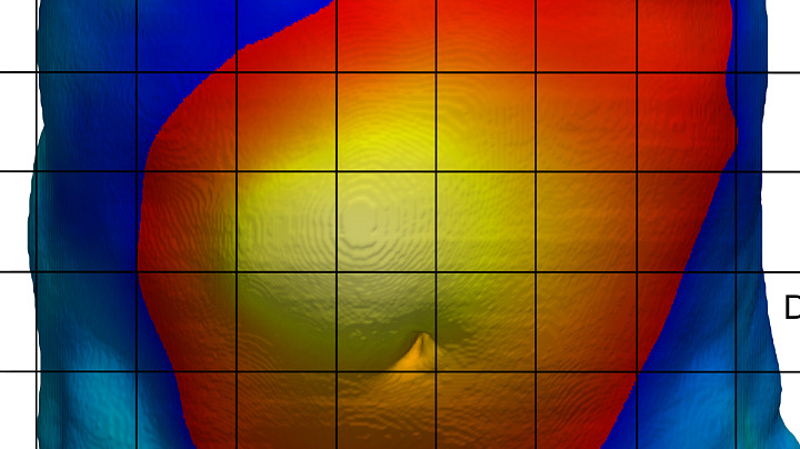 3D imaging yields drastic improvement in hernia surgery outcomes